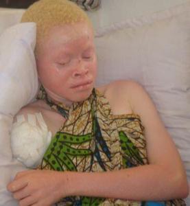 A victim of attacks on albinos in Tanzania