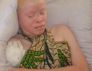 A victim of attacks on albinos in Tanzania