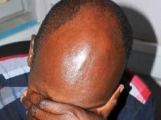 Mozambique Bald Men Attacks