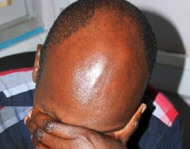 Mozambique Bald Men Attacks