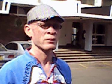 Albinism in Malawi