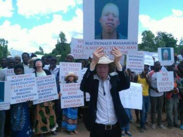 albinism Malawi