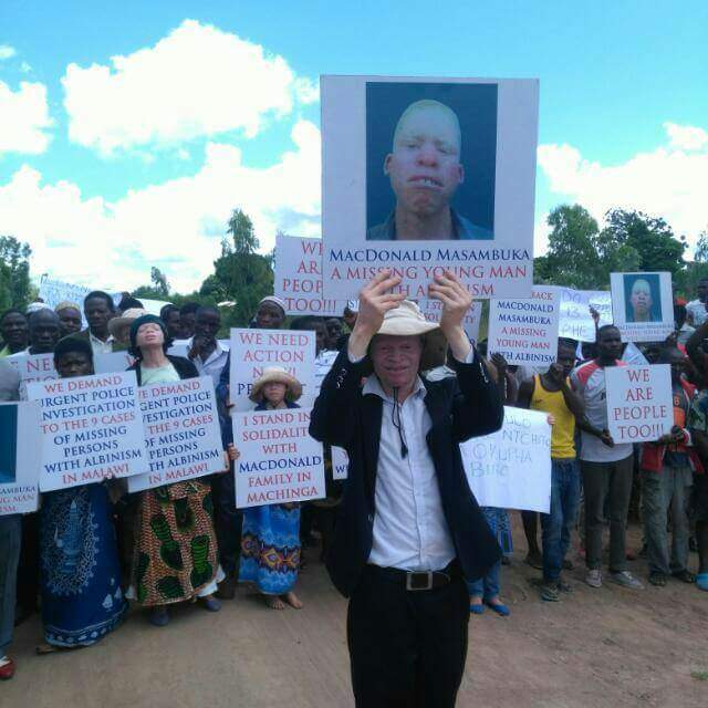 albinism Malawi