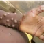 MonkeyPox