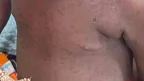 Child Suffering From Measles- Malawi24